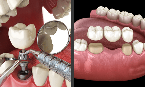 Nên trồng răng bằng cấy ghép implant hay cầu răng