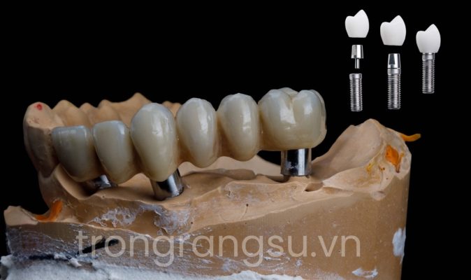 Trồng răng implant toàn hàm