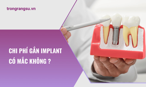 Chi phí gắn implant có mắc không ?