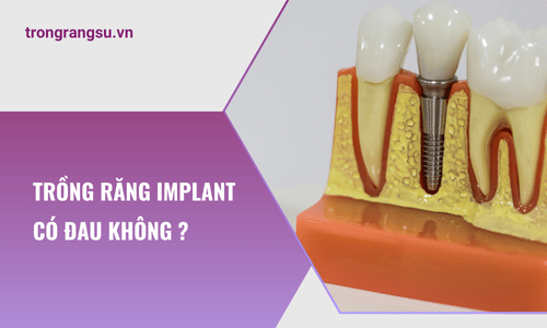 Trồng răng Implant có đau không ? 